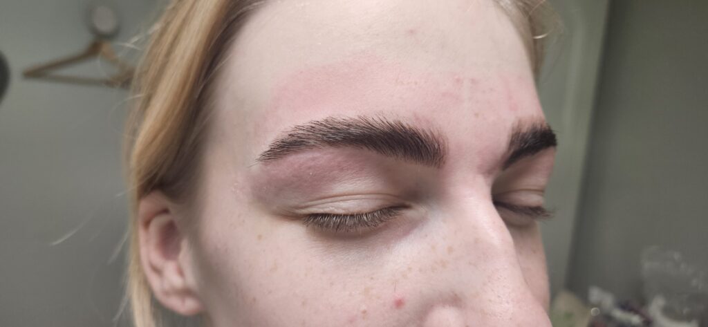 browlift après